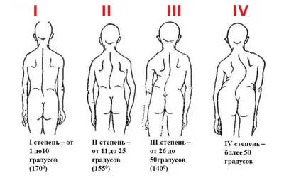 10 лучших упражнений при сколиозе у взрослых: комплекс эффективных  тренировок для укрепления мышц спины