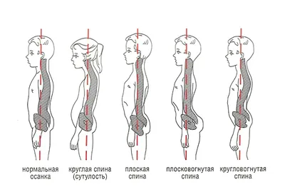 Кифоз позвоночника – это искривление позвоночника выпуклостью назад,  горбатость или сутулость. При кифозе изгиб позвоночника.. | ВКонтакте