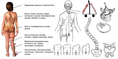 Тренировки при сколиозе — можно ли заниматься