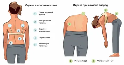 Нарушение осанки у детей, причины, профилактика, упражнения