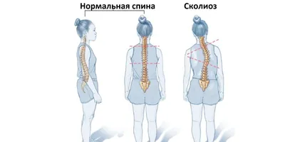 Что при сколиозе можно делать – Доктор Позвонков