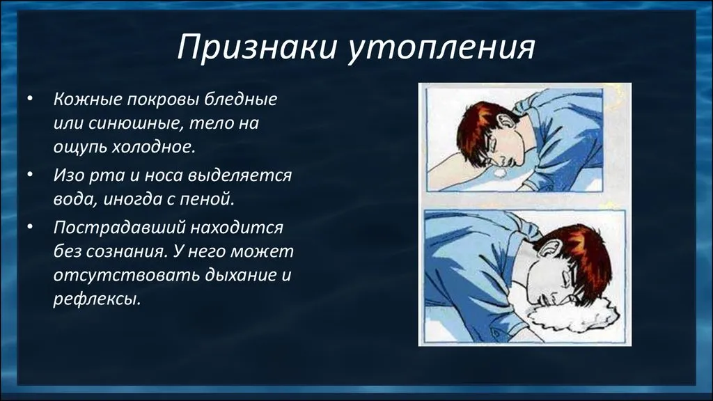 Упал и пена изо рта. Утопление причины признаки осложнения первая медицинская помощь. Признаки истинного утопления.