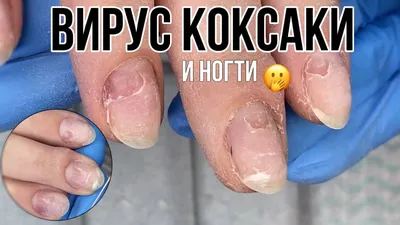 ЦПМСД 6 - 😲 Вирус Коксаки - это энтеровирусная инфекция,... | Facebook