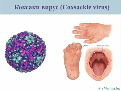 Новый вирус «руки-ноги-рот» — Новости Шымкента