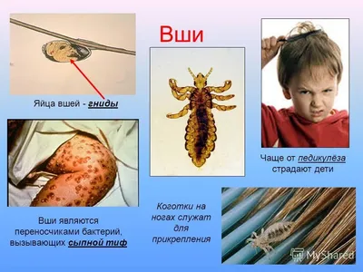 Правда или миф, что вши любят чистые волосы - Лента новостей Тольятти