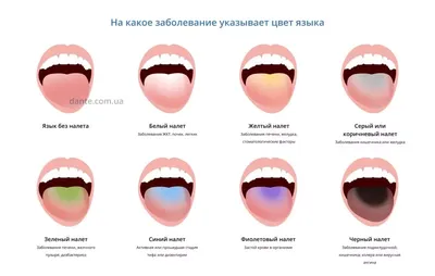 Бактериальная Инфекция Заболевания Языка — стоковые фотографии и другие  картинки 2015 - 2015, Анемия, Антисанитарный - iStock