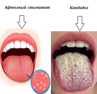 Географический язык - причины появления, при каких заболеваниях возникает,  диагностика и способы лечения