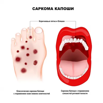 Глоссит - виды, причины, симптомы, методы лечения