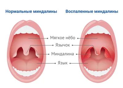 Саркома Капоши - симптомы острой и хронической форм, стадии и признаки у  мужчин и женщин, причины появления, диагностика и лечение заболевания