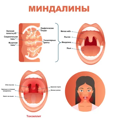 Наросты на языке в полости рта