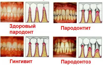 [85+] Заболевания полости рта в картинках обои