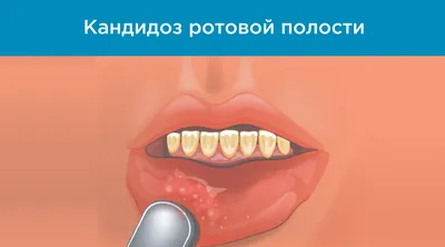 Лечение стоматита ⚡ по старой цене в Москве ⚡ | Стоматология Ⓜ️Речной  вокзал, Ⓜ️Беломорская