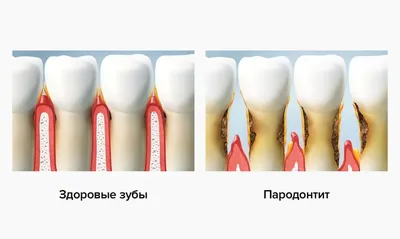 Комплексная гигиена полости рта | Примеры работ - фото до и после