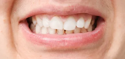 Болезни зубов у человека: названия, фото, симптомы