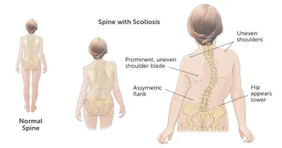 Сколиоз: симптомы, причины, диагностика и лечение