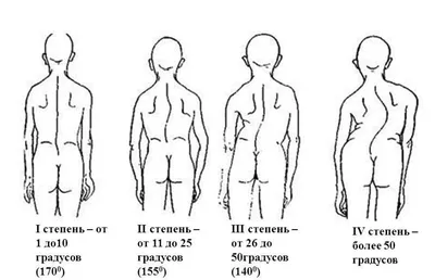 Упражнения при сколиозе (1 уровень) - YouTube