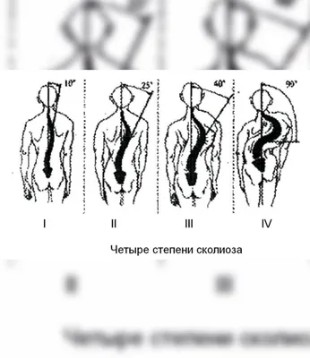 Упражнения лечебной йоги, которые помогут при сколиозе