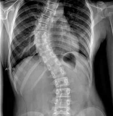 S-Образный сколиоз 1-2-3 степени, причины, лечение грудо-поясничного отдела  позвоночника